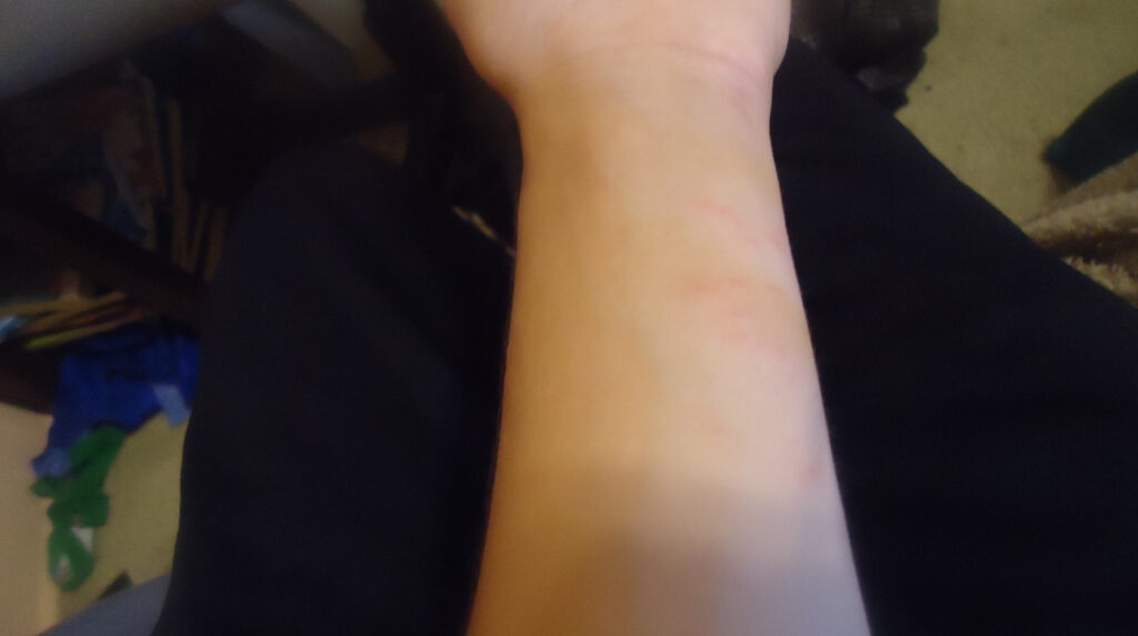 Dermatitis alérgica en Panamá: erupción con ronchas y vesículas rojas por contacto con una planta alergénica en la piel de un adulto