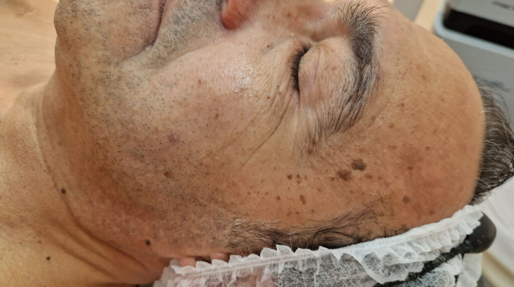 Queratosis seborreicas en Panamá: lesiones marrones de aspecto adherido en el rostro de un adulto durante una consulta