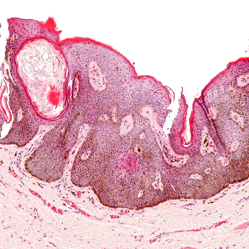 corte de la piel al microscopio que muestra el engrosamiento superficial característico de la queratosis seborreica