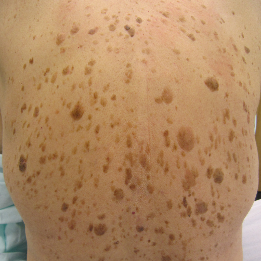 múltiples queratosis seborreicas marrones de bordes definidos en la espalda de un adulto