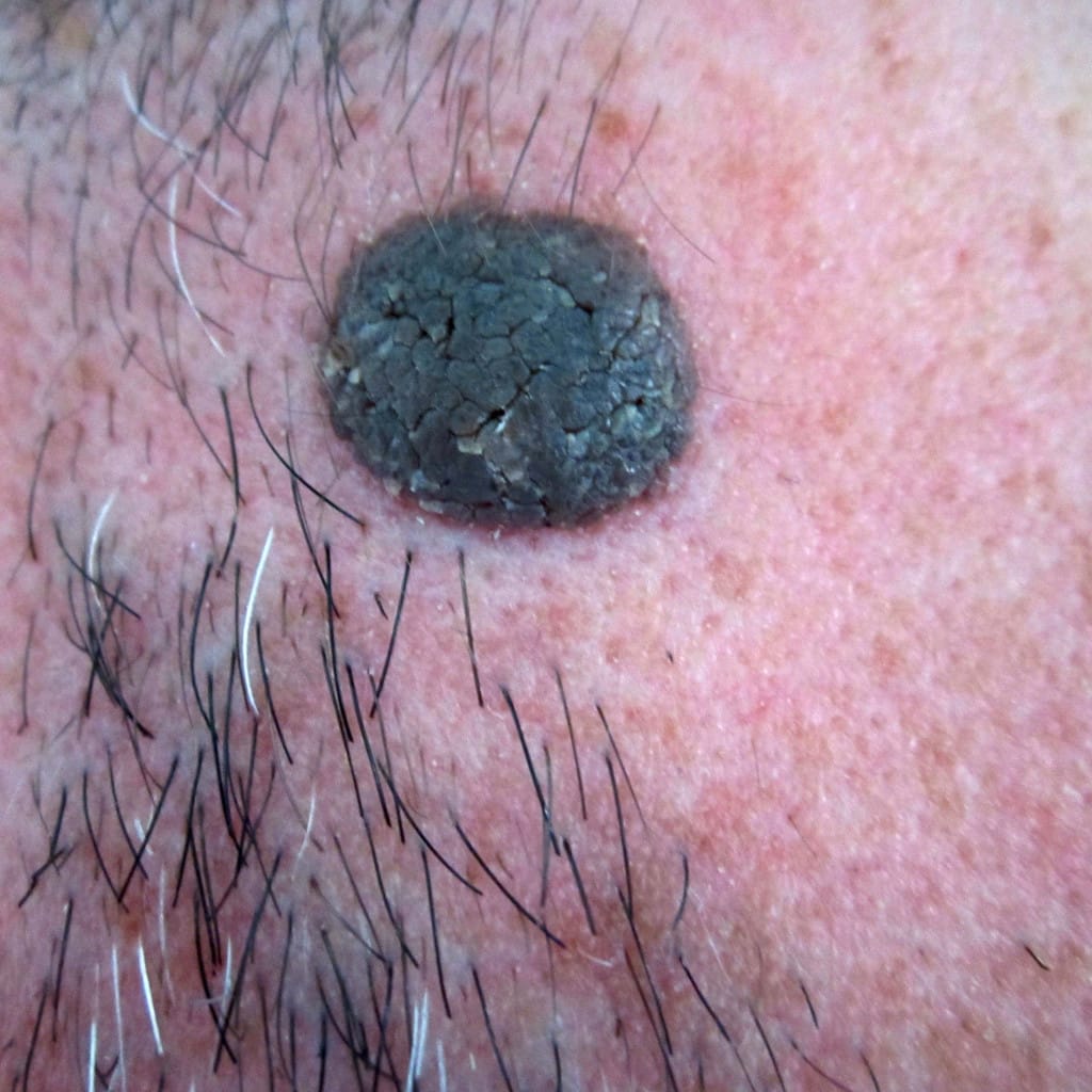 lunar de superficie irregular y color oscuro, un rasgo que conviene revisar con un dermatólogo