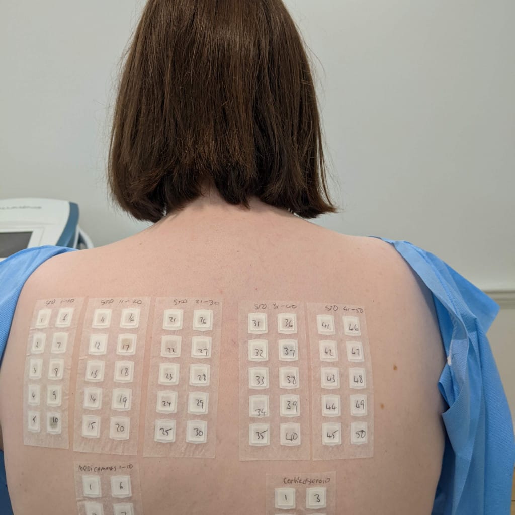 patch test de alergia en la espalda de un paciente adulto para diagnosticar dermatitis de contacto alérgica