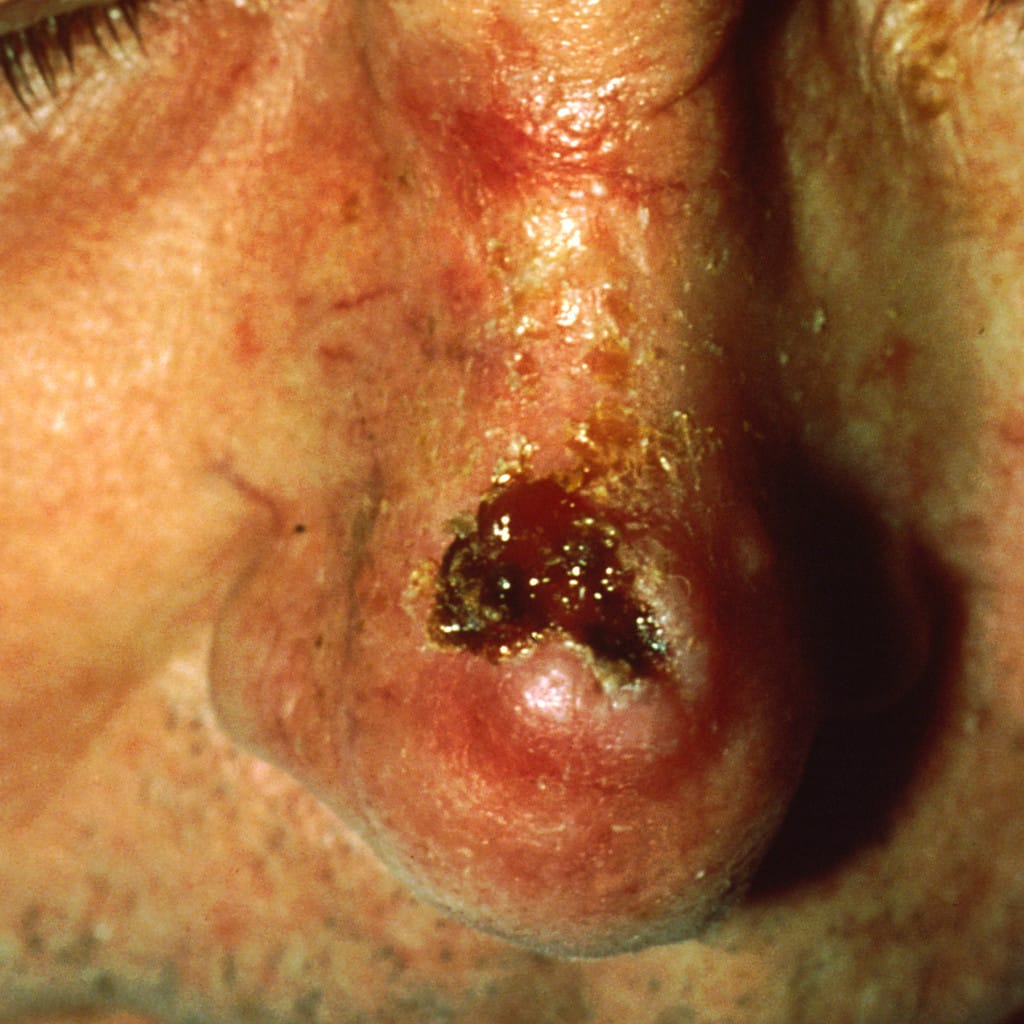 carcinoma espinocelular como lesión elevada con costra en la nariz de un adulto con daño solar
