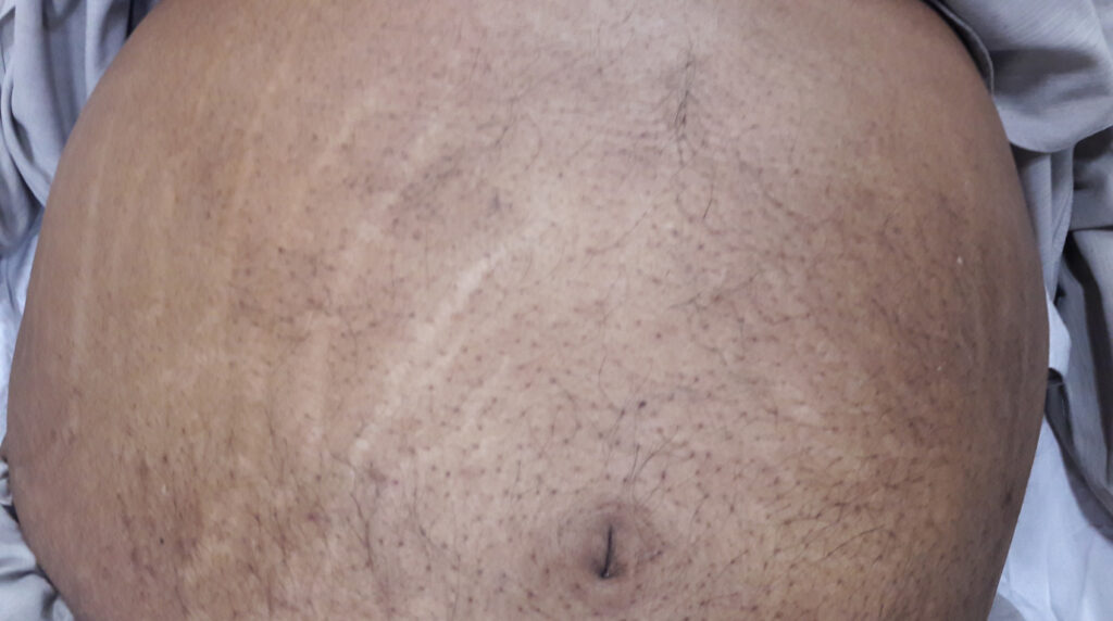 Estrías en Panamá: estrías blancas y nacaradas en el abdomen de un adulto