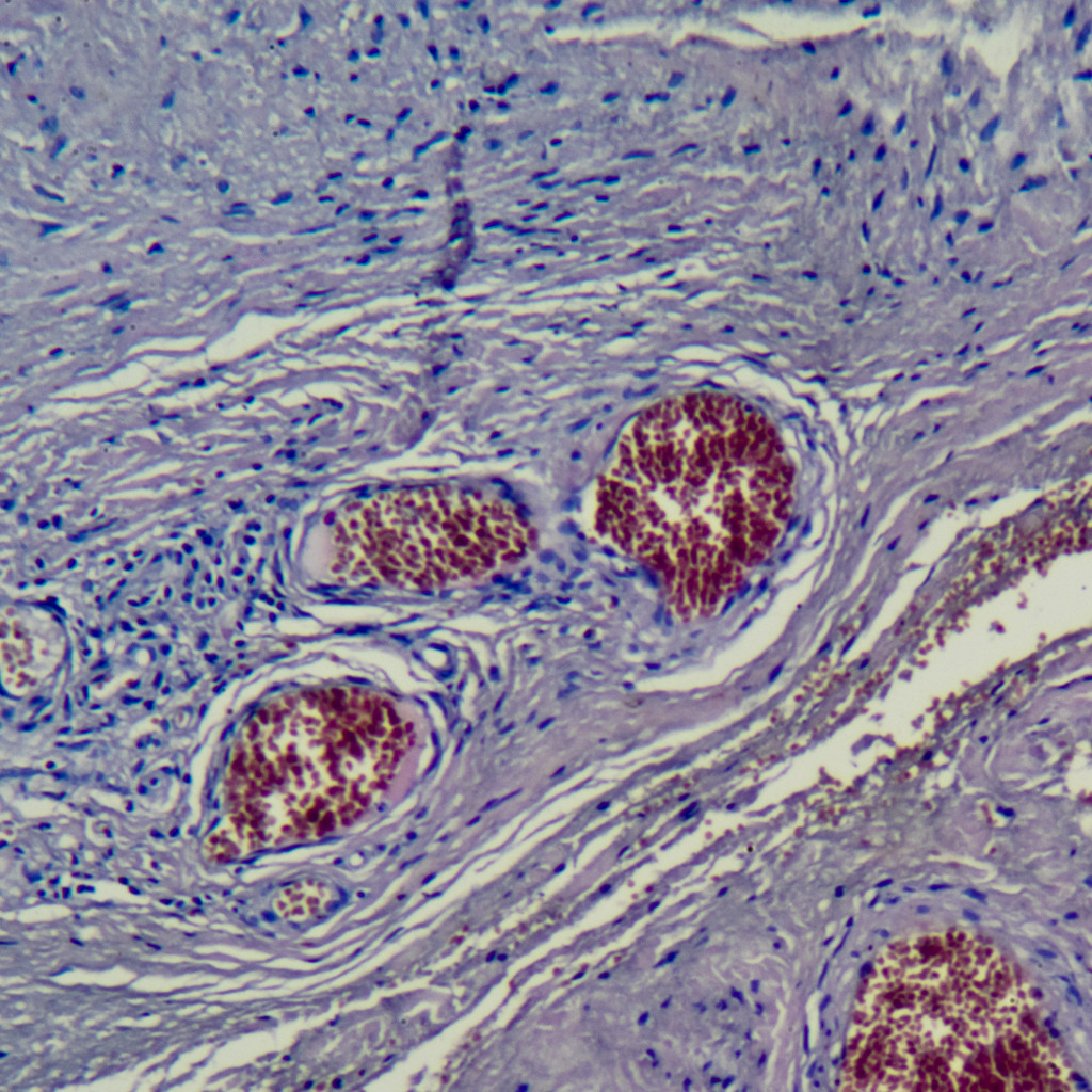 corte al microscopio de un hemangioma capilar, la agrupación de vasos pequeños que forma el punto rubí
