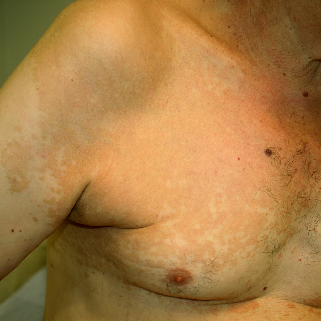 manchas claras y rosadas de bordes definidos sobre el hombro y el pecho de un adulto, signos de pitiriasis versicolor