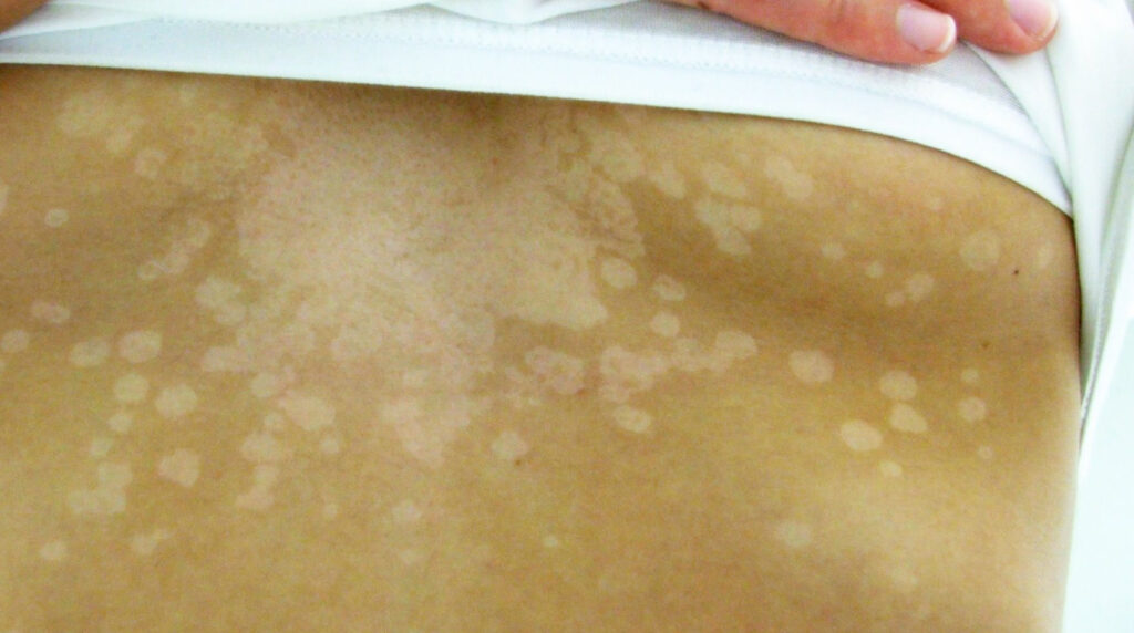 Pitiriasis versicolor en Panamá: múltiples manchas claras y redondeadas con descamación fina en la espalda de un adulto