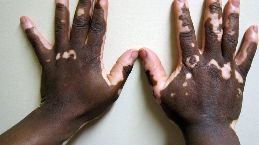 Vitíligo en Panamá: manchas blancas en las manos de un adulto